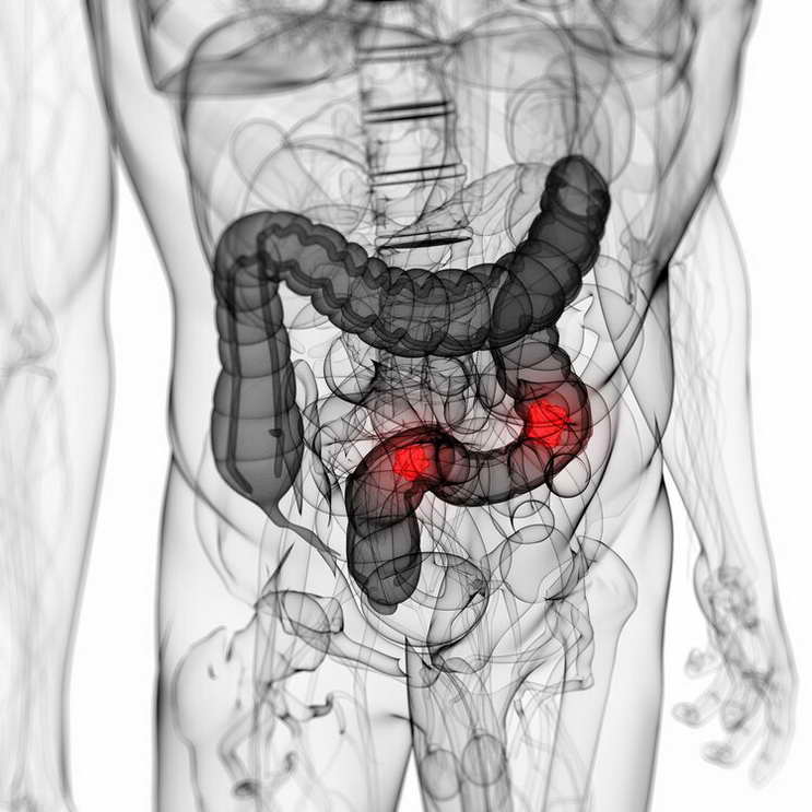 有一種致命的粗心叫“把結腸癌當闌尾炎”！6個症狀都要認清