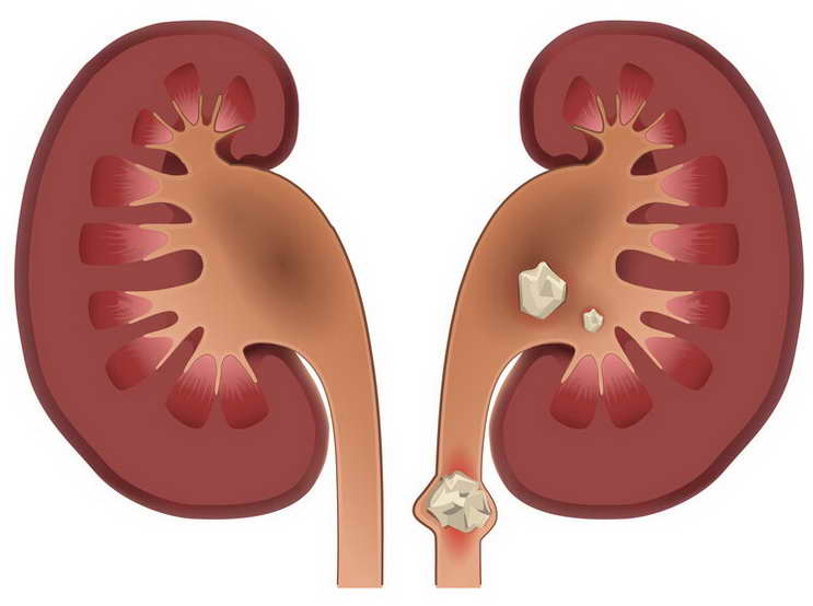 為什麼“腎結石”越來越多？再三勸說：6個原因別碰，腎會感謝你