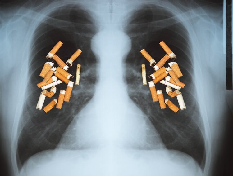 90%的肺癌与吸菸有关！一辈子吸菸的人，会有多少人死于肺癌？