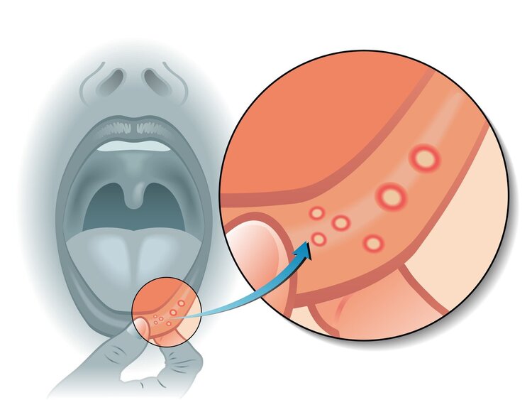 体内有癌，嘴知道？提醒：口腔出现这5种异常，警惕或是癌症到访