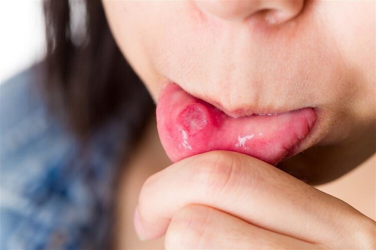 体内有癌，嘴知道？提醒：口腔出现这5种异常，警惕或是癌症到访